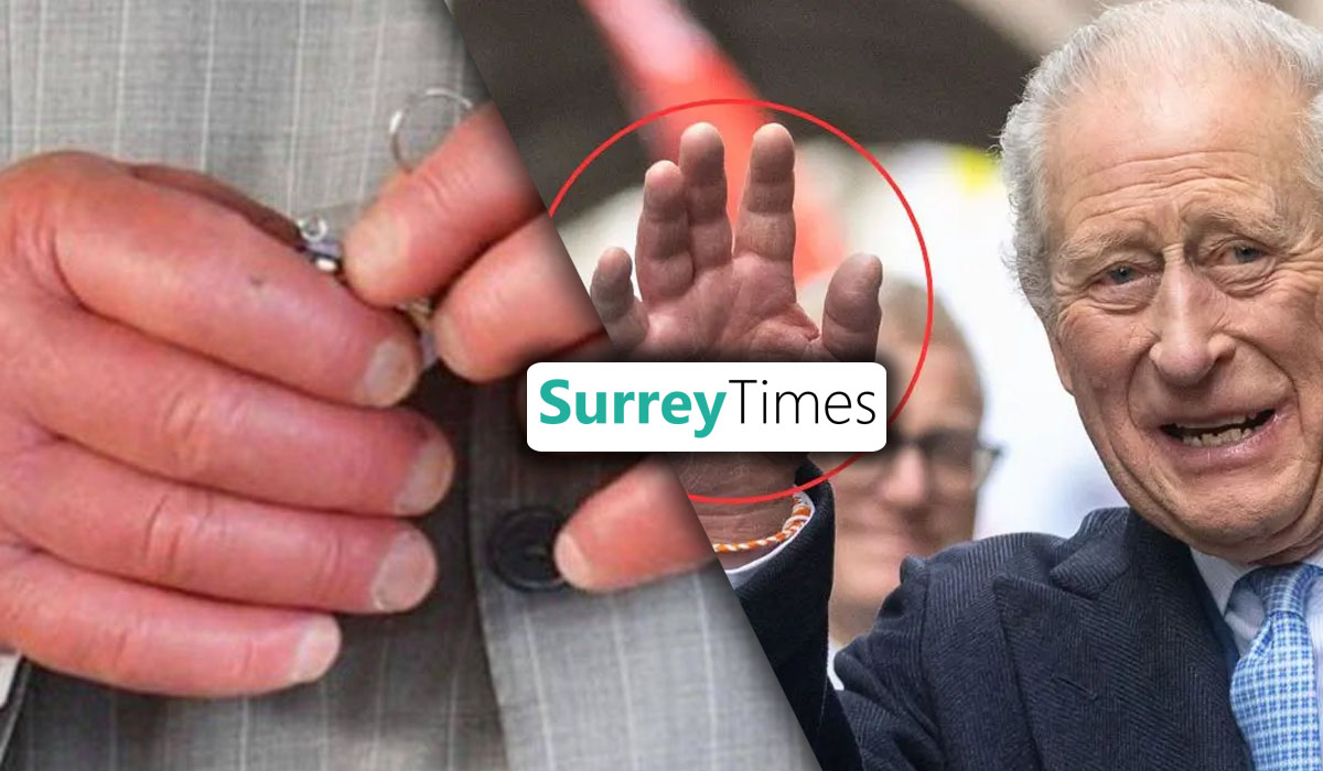 King Charles Fingers Condition